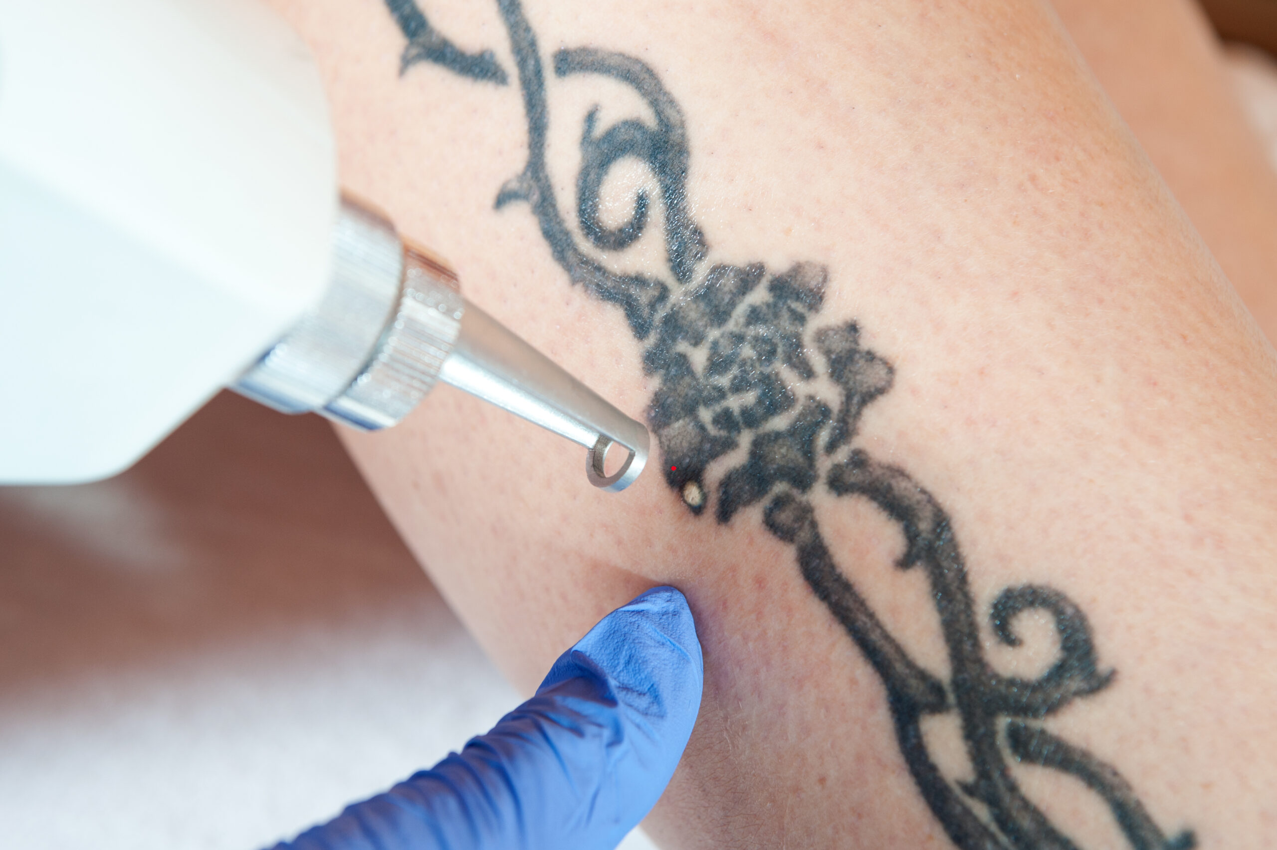 Life | Free Full-Text | Q-Switched 1064/532 nm Laser with Nanosecond Pulse  in Tattoo Treatment: A Double-Center Retrospective Study